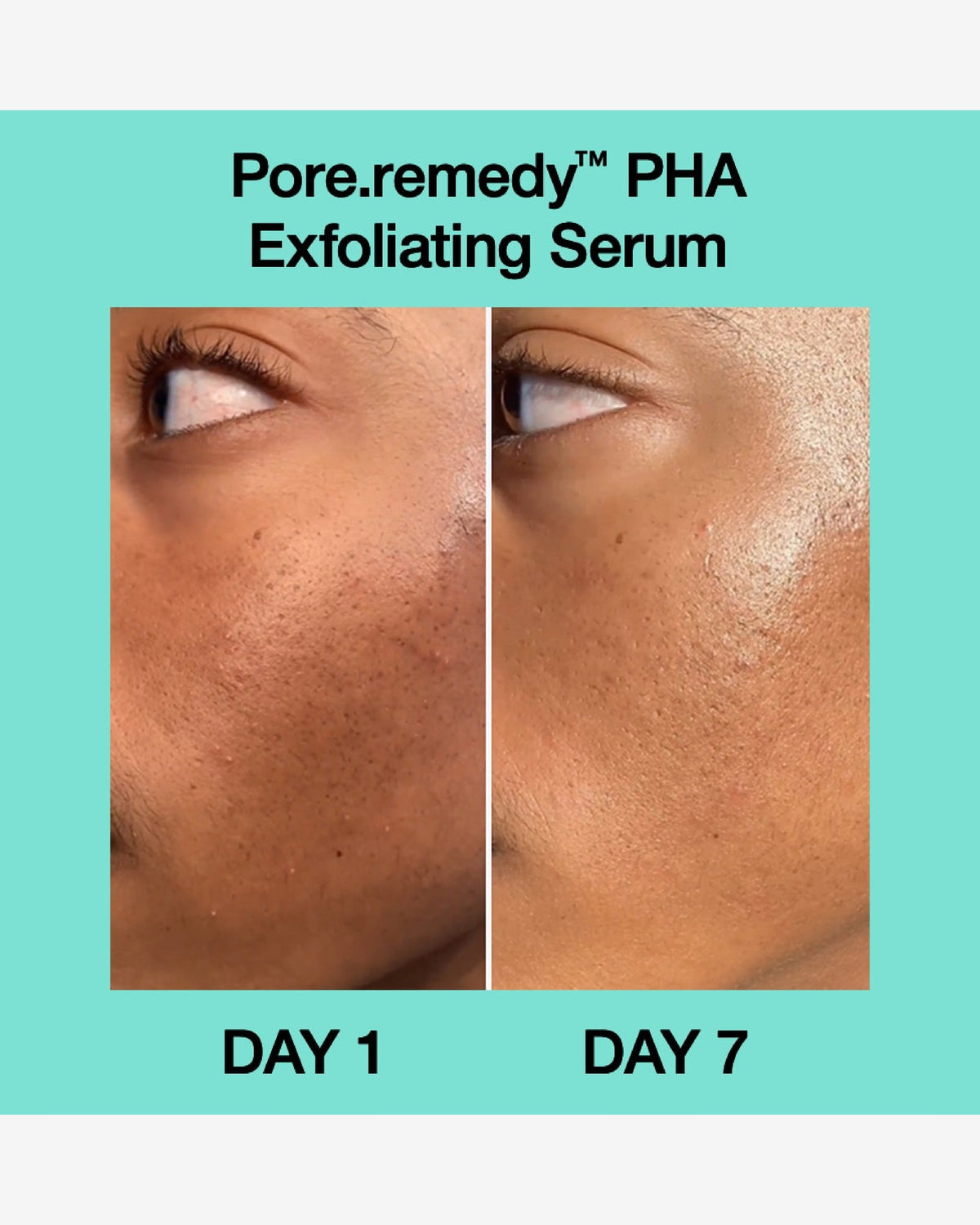 Pore Remedy™ Pha Exfoliating Serum